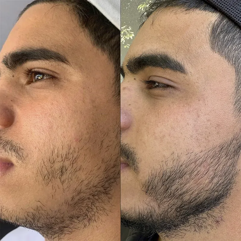 Barba 01